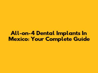 All-on-4 Dental Implants In Mexico: Your Complete Guide